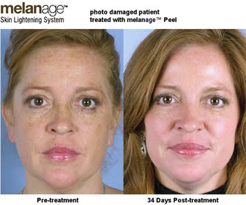 Fight Sunspots and Melasma with a Chemical Peel - Dontage