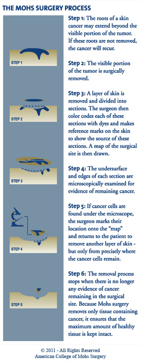 Mohs Micrographic Surgery | Dermatologists Nacogdoches